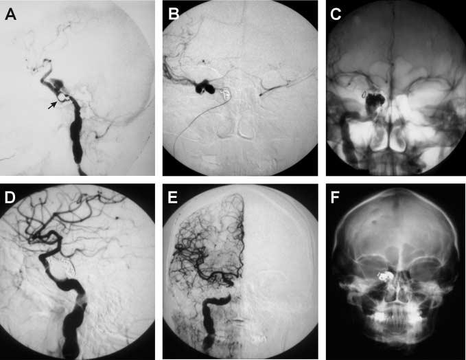 608 Übersicht Abb. 2 Die 54-jährige Patientin entwickelte nach einem Schädel-Hirn-Trauma einen Exopthalmus, eine Chemosis und eine Ptose rechts (A).