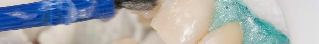 Bleaching in der Zahnarzt-Praxis: Viele Patienten sind erstaunt darüber, wie schnell die Zähne hell werden!