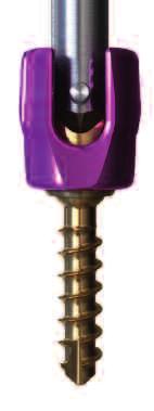 Schraubenziehermontage Schraubenzieher an Polyaxialschraube anbringen Sicherstellen, dass der Schraubenzieher in der zurückgesetzten Position ist.