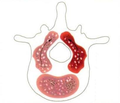 Abbildung 2 zeigt die 3 Ossifikationskerne eines Wirbels zum Zeitpunkt der Geburt (13), zwei befinden sich im Wirbelbogen und einer im Wirbelkörper.