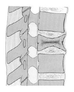 1.3.3.1.1.3 Typ A1.3 Wirbelkörperimpression Diese Verletzung wird hauptsächlich bei Osteoporose der Wirbelkörper festgestellt.