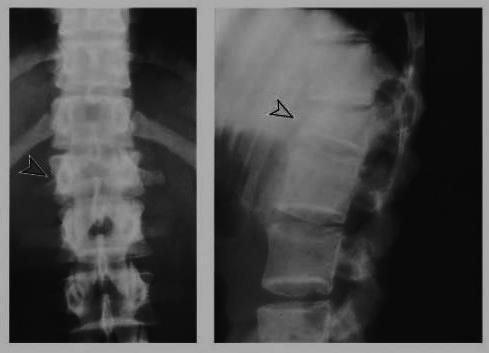 Zur Standarddiagnostik gehört eine native Röntgenaufnahme des verletzten Bereiches der thorakolumbalen Wirbelsäule in zwei Ebenen, im a.-p.