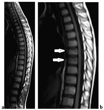 Eine Magnetresonanztomographie zeigt hingegen eher bestehende Verletzungen des Rückenmarks und der Spinalnerven, des Bandapparates und der Bandscheiben und auch des Knochens an.