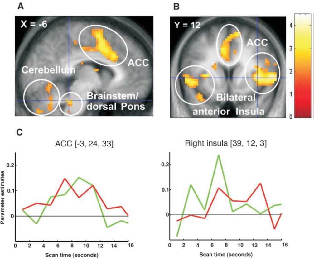 Empathie «Motor response» A + B: Shared networks when pain was applied