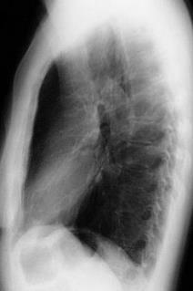Allgemeine Anatomie des Herzens: Lage (linksanliegend) 1) Aortenbogen/ 2) Pulmonalarterie/ 3) linker Vorhof, 4)