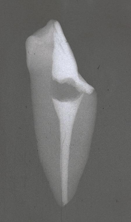 - 54 - Abb. 7: Röntgenbild eines unteren Prämolaren der Gruppe 2 (Handaufbereitung, laterale Kondensation, RSA ), aufgenommen in mesial/distal-exzentrischer Projektionsrichtung.
