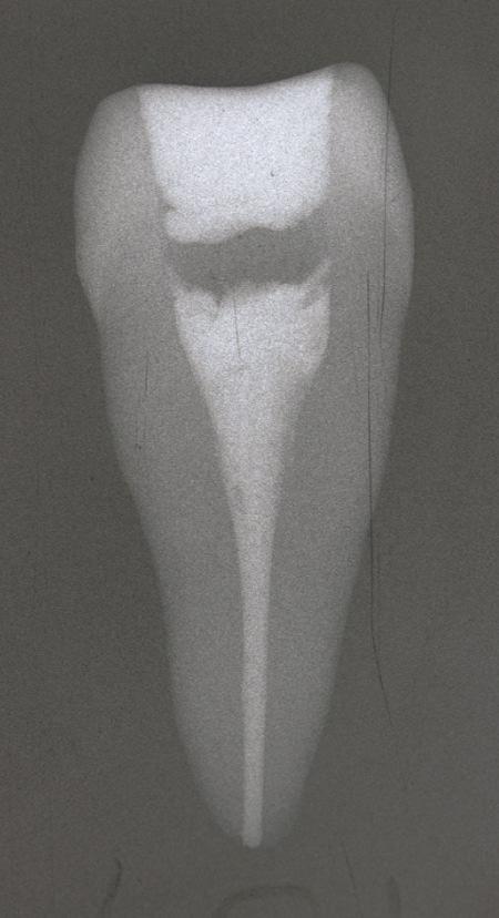 Die Untersuchung dieses Zahnes hinsichtlich des Kriteriums Distanz des apikalen Endes der Wurzelkanalfüllung zum röntgenologischen Apex ergab einen idealen Wert von 0,98 mm Distanz zum