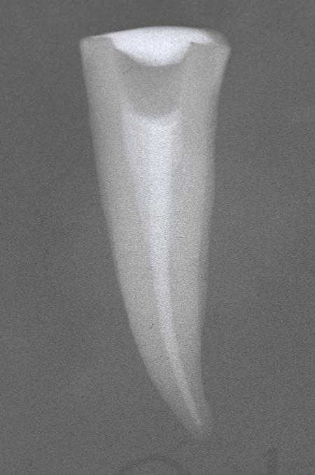 - 56 - Abb. 11: Röntgenbild eines oberen Prämolaren der Gruppe 7, aufgenommen in der orthoradialen Projektionsrichtung.
