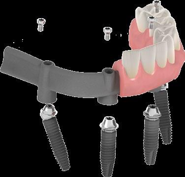 In den letzten zehn Jahren sind implantatgetragene festsitzende Versorgungen für den gesamten Zahnbogen die Standardbehandlung für unbezahnte Patienten geworden.