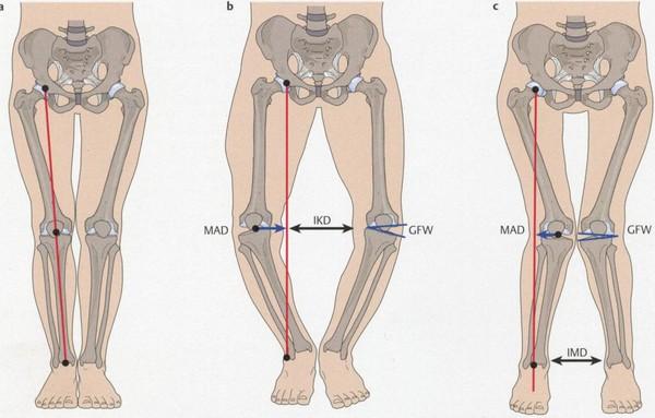 Beinachsenkorrektur (Umstellungsosteotomien am Knie) Warum ist eine Beinachsenkorrektur notwendig? Alternativen des Eingriffes Welche Operationen gibt es?
