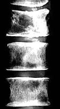 44 Abbildung 33: Vertebrale Osteolysen. Nach Kyphon Sunnyvale USA Inc.. 3.4.5 Adjuvante Stabilisierung Hierzu zählen Augmentierungen von Wirbelkörpern, die durch ihre osteoporotische Trabekelstruktur