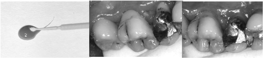 Fluorid Wurzelkaries Dentin und Wurzelzement sind Kariesanfälliger als Schmelz (Hoppenbrouwers et al. 1986) Fluorid ist auch hier wirksam 2 3malige Spülen mit AmF-SnF2 Kombinationen (Banoczy u.