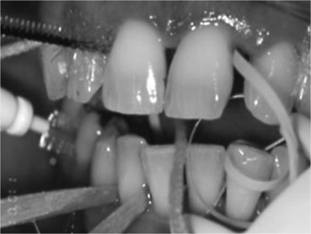 Zahnpflege mit neutrale Mundtrockenheit Empfehlungen Fluoridgelee (NAF, SnF 2 )
