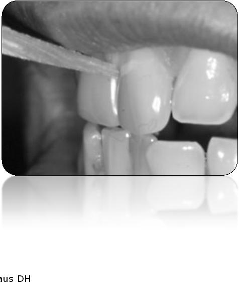 Zahnhölzchen Medizinische Zahnhölzer Dreieckige Form Passen sich in der Form