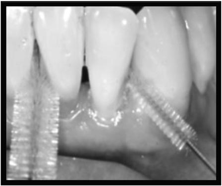 Zahnzwischenraumbürstchen Interdentalbürste Wenn der Interdentalraum schon vergrößert ist Es gibt unterschiedliche Größen Ohne Zahnpasta Mehrfach zu verwenden Zahnzwischenraumplege