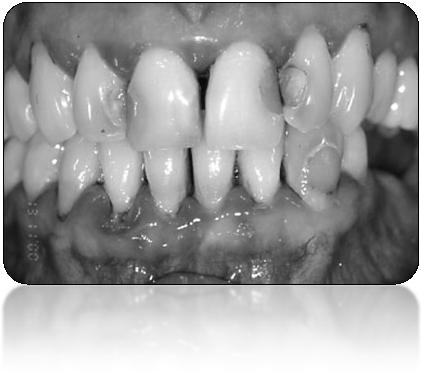 Wie entsteht Karies? Bakterien kleben sich an die Zahnoberfläche Diese bilden Säuren Welche den Zahn entmineralisieren.