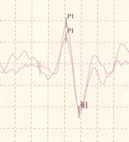 Abbildung 8: cvemps über dem Musculus sternocleidomastoideus während akustischer Stimulation über die Luftleitung, Ordinate: Amplitude in µv, Abszisse: Zeit in ms (links: Normalbefund, rechts: