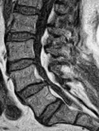 7 L4/5 Alter: 65 ID: 08-08 -MRI: Das Fettgewebe im Wirbelkanal verlagerte sich