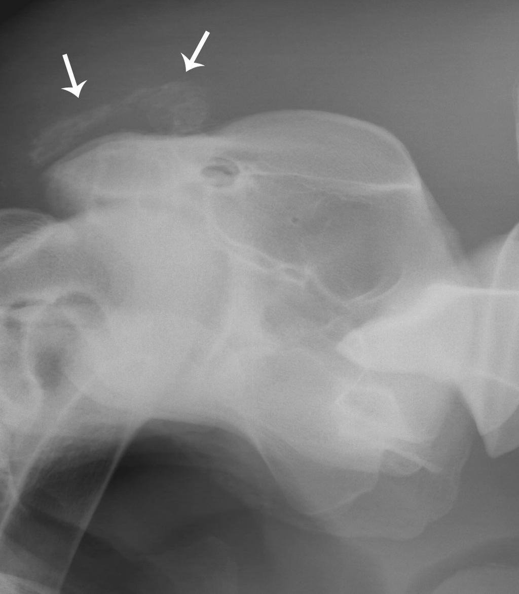 IV. Ergebnisse 67 Abb. 22: Röntgenbild des Atlasbereiches des Patienten H8. Dorsal der Atlaskontur befindet sich eine streifige Verschattung (siehe Pfeile).