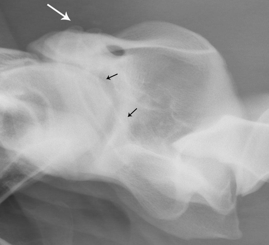 IV. Ergebnisse 72 Auf den Röntgenbildern von insgesamt 45 Pferden (45/138 = 33%) waren Befunde zu finden, die den oben beschriebenen Veränderungen im Dorsalbereich des ersten Halswirbels stark
