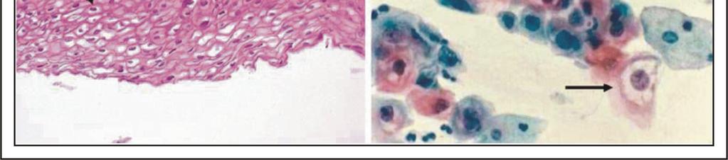 Ein Zervixkarzinom entwickelt sich in vier Stufen: 1. Infektion mit HPV 2. Viruspersistenz 3. Progression persistierend infizierter Zelllinien zu Krebsvorstufen 4.