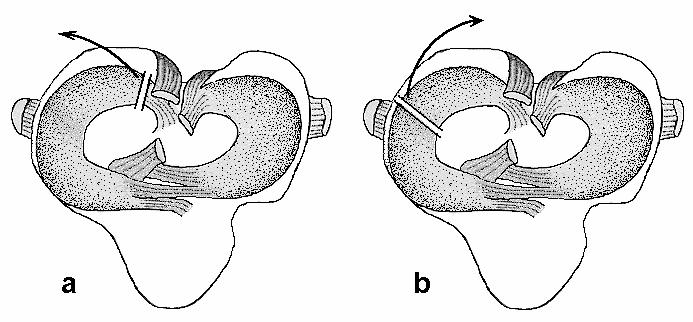 Abb. 6: Meniskusrelease nach SLOCUM u. DEVINE SLOCUM (1998): a) Durchtrennung des Lig.