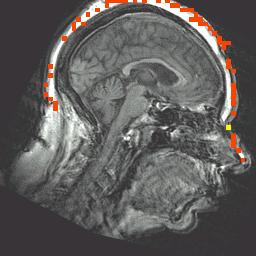 digitalisierten Kopfform mit Hilfe der Coils (Inion, Cz), der digitalisierten anatomischen Referenzpunkte