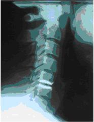 Halswirbelsäule 03 Die Operation ist bei therapieresistenten Schmerzen, neurologischen Ausfällen (Lähmung im Arm oder Bein, Blasen- bzw.