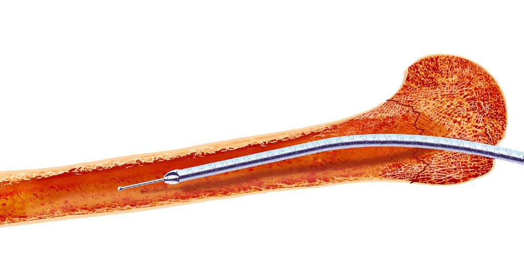 5 Für das Säubern des Kanals stehen mehrere flexible kanülierte Bohrer (3,5 mm, 4,5 mm, 5,5