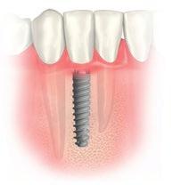 0 Implantate sind ausschließlich für Einzelzahnversorgungen indiziert.