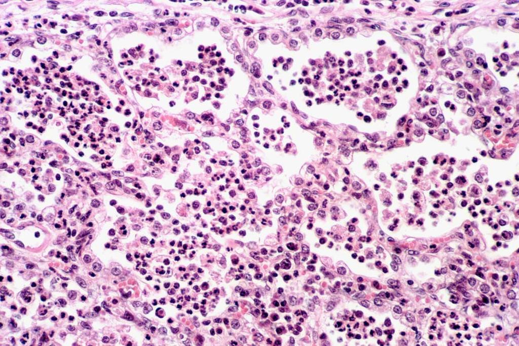Hyperplasie Typ II Pneumozyten zahlreiche Alveolen sehen