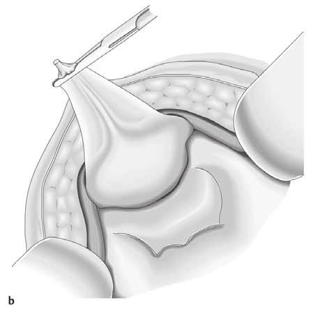umbilicalia mediana V-förmige Inzision des Peritoneums in Richtung beider Iliakalachsen entlang des Lig. umbilicale medianum ( Abb.