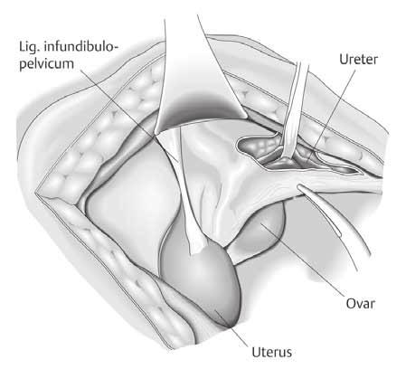 Operative Techniken 75 Darstellen beider Ureteren in Höhe der Gefäßkreuzung ( Abb. 4) Das Peritoneum wird bds. entlang der Ureteren weiter in Richtung Douglas-Raum inzidiert. Die Ligg. rotunda bds.