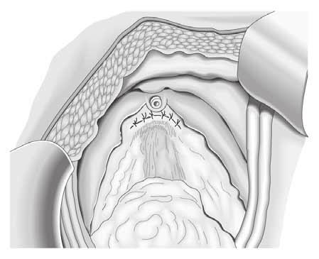 Merke Ist eine orthotope Harnableitung geplant, muss jede Präparation kaudal der endopelvinen Faszie bzw.