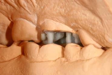 ;-) Auf der oralen Außenform finden wir alle C - Kontakte. Zuerst wird die Außenform des mesialen Höckers modelliert 6 und dann des distobukkalen Höckers.