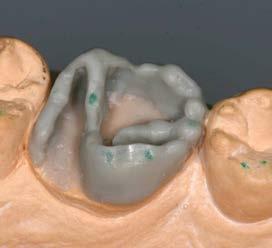 6 Der mesiale Höcker ist der wuchtigste im ganzen Zahn. Seine Außenform zu modellieren ist gar nicht so einfach. Wichtig ist die distale Begrenzung zur Christa transversa.
