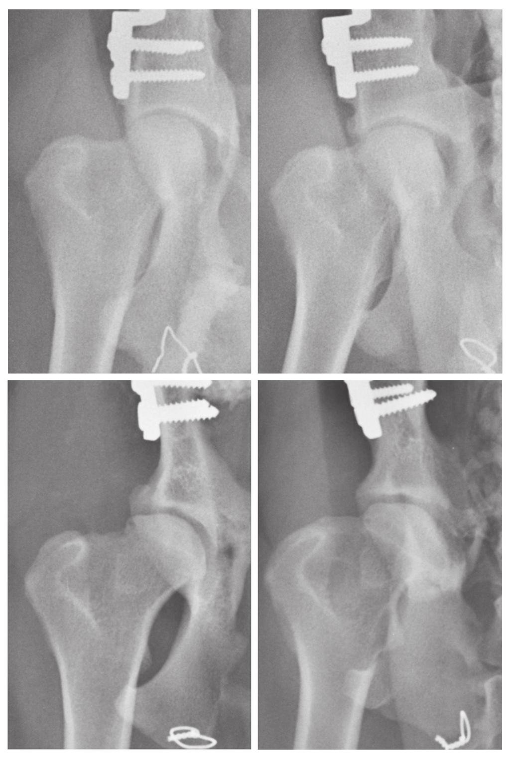 Abb. 2: Standards für Arthrosegrade postoperativ: Grad 0 (links oben): keine röntgenologisch sichtbare Arthrose; Grad 1 (rechts oben): Morgan Linie, Sklerosierung des kraniodorsalen Pfannenrandes,