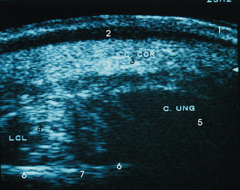 Das folgende sonographische Bild (Abb. 28) entstand mehr lateral als das vorherige (Abb. 27).