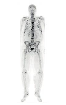 C FRAGESTELLUNGEN IN DEN FACHBEREICHEN Knochendichtemessung Indikation: Osteoporose Ganzkörperszintigraphie, -SPECT/CT Indikation: Diagnostizierung von Skelettteilen mit verstärktem