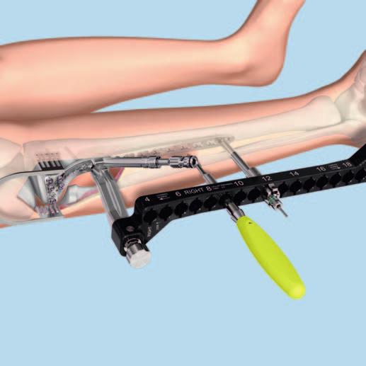 Schrauben in den Plattenschaft einbringen 1 Kortikalisschrauben 3.5 mm in den Plattenschaft einbringen Instrumente 03.127.010 Führungshülse für Zielbügel-Instrumente für VA-Platten 3.5 03.113.