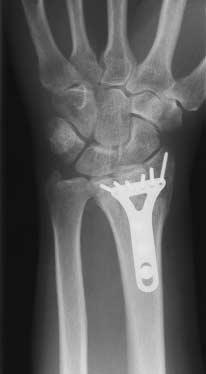 2-mm fixed-angle screws Sichere Fixation des ulnaren Kantenfragmentes Secure fixation of the ulnar border