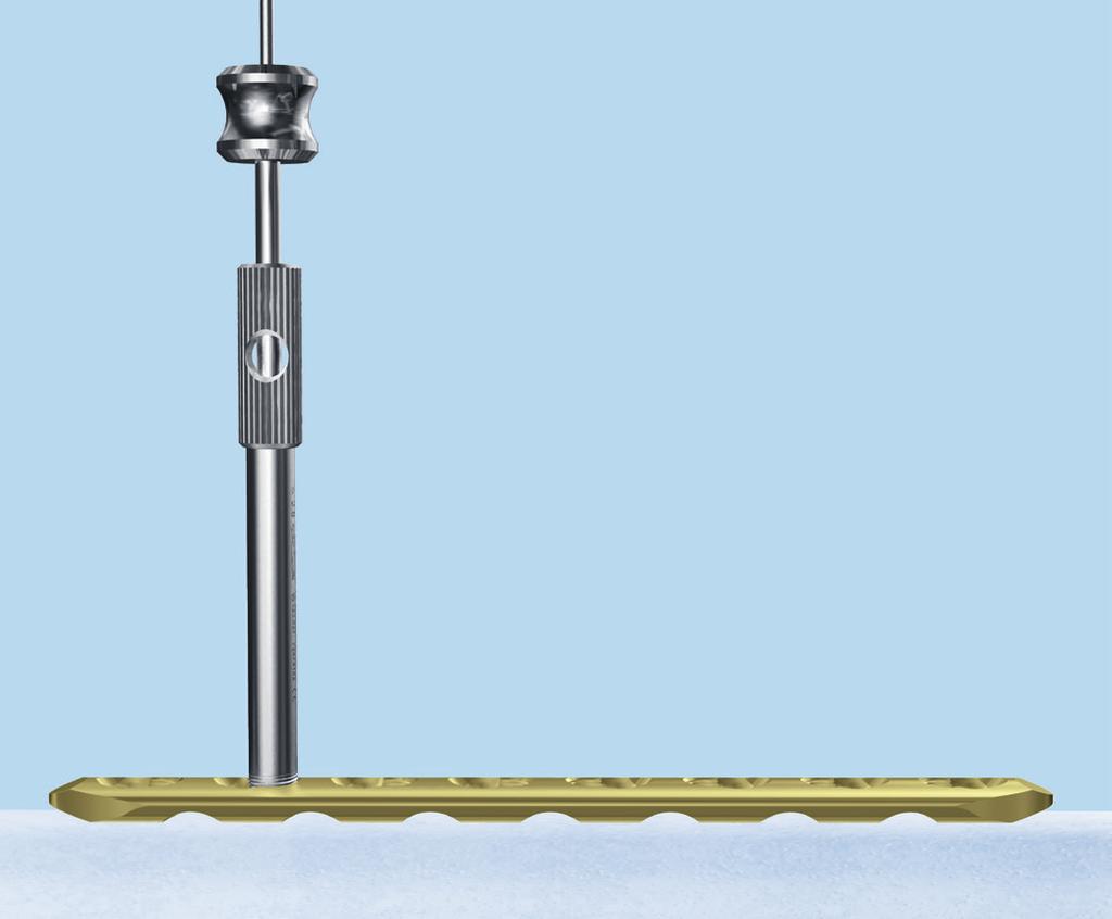 5 Option: Kirschnerdraht einbringen Instrumente Kleinfragment 323.055 Führungsbüchse für Kirschnerdraht Ø 1.6 mm, Länge 70 mm, zu Nrn. 323.027 und 323.054 oder 324.