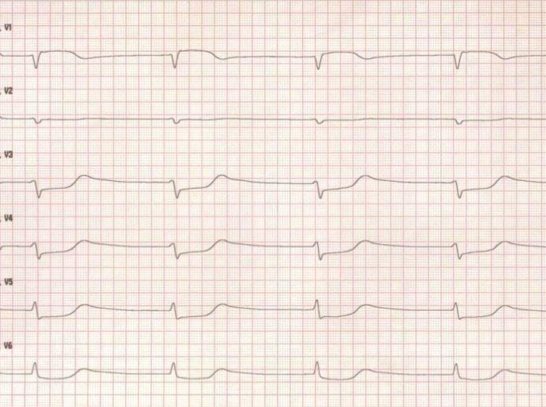 Fallbeispiel: Zyanidintoxikation 34-jähriger Mann 15 Uhr auf Parkbank vor Reha-Klinik leblos aufgefunden bei V.a. LAE Reanimation und Lyse im Rucksack des Patienten leere 0.