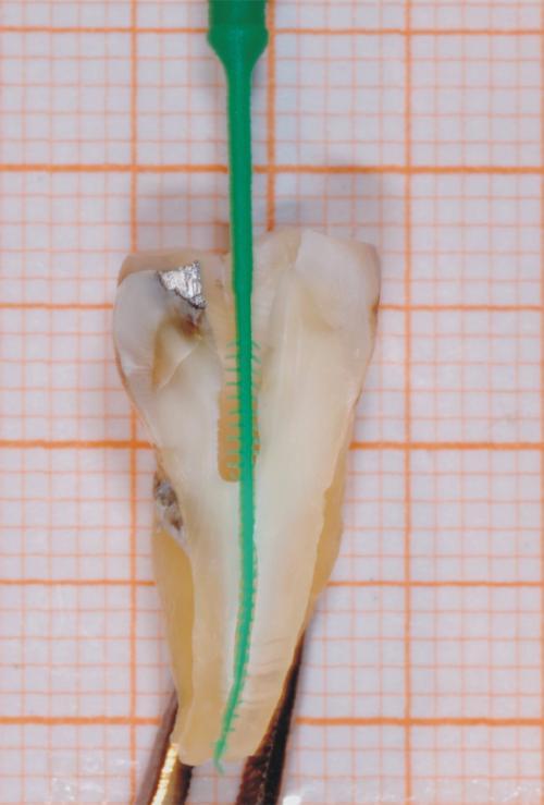 Material und Methode Abbildung 3: CanalBrush im Wurzelkanal. 4.4 Versuchsaufbau Die Zähne wurden den einzelnen Versuchsgruppen randomisiert zugeordnet (4.
