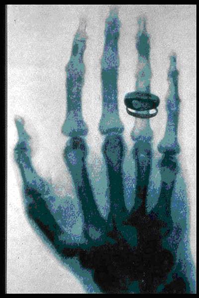 2.1. VERWENDETE MODALITÄT 7 webe entdecken, zum Beispiel bei der Mammografie. Wie stark die Röntgenstrahlung beim Durchtreten des jeweiligen Gewebes abgeschwächt wird, besagt die Hounsfield Unit (HU).