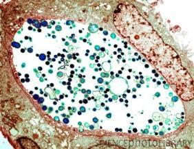 Karzinom assoziiert (class I carzinogen) Staphylococcus aureus ruft Infektionen der Haut und Atemwege,