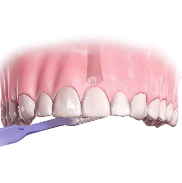 EINZELZAHNVERSORGUNG Wichtige zu reinigende Bereiche Implantatgetragene Zahnkrone, ober- und unterhalb des