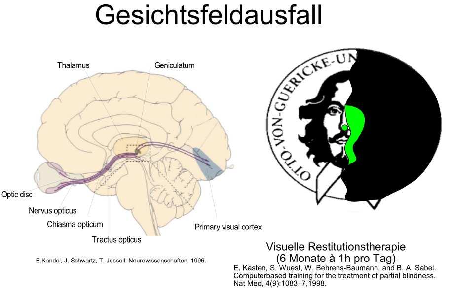 SOM, Gesichtsfeldausfall