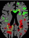 . Neuroaxonaler Schaden DTI; Atrophie... Eisenablagerungen: Eisen-Mapping R2; QSM  .