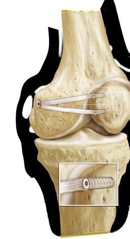 Transplantatfixation im Knochen Die Zwei-Bündel Rekonstruktion*: Anatomisch Eliminiert die
